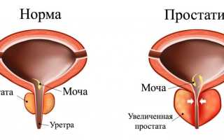 Лечение хронического простатита народными средствами. Собрание рецептов
