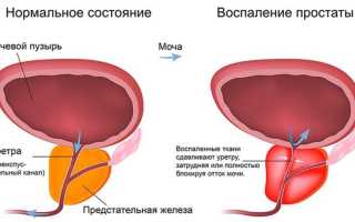 МКБ-10: воспалительные болезни предстательной железы