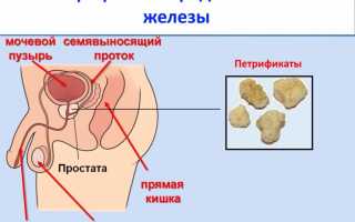 Кальцинаты предстательной железы — что это такое и как лечить?