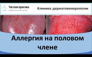 Сыпь на половом члене после полового акта с молочницей