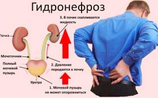 Операция при гидронефрозе почек