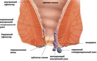 Можно ли греть геморрой? Врачи рассказали о всех рисках