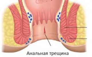 Как можно вылечить анальную трещину?