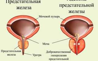 Симптомы и все методы лечения аденомы простаты у мужчин