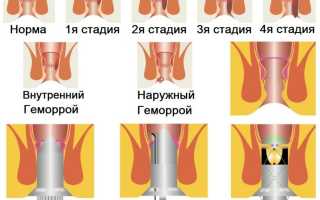 Эффективное лечение геморроя Алоэ. Мы нашли для Вас самые популярные рецепты