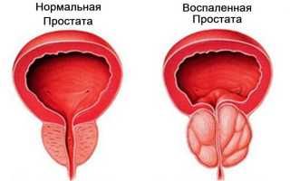 Недорогие и эффективные таблетки от простатита