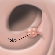 Полипы желчного пузыря симптомы и лечение полипы желчного пузыря симптомы и лечение