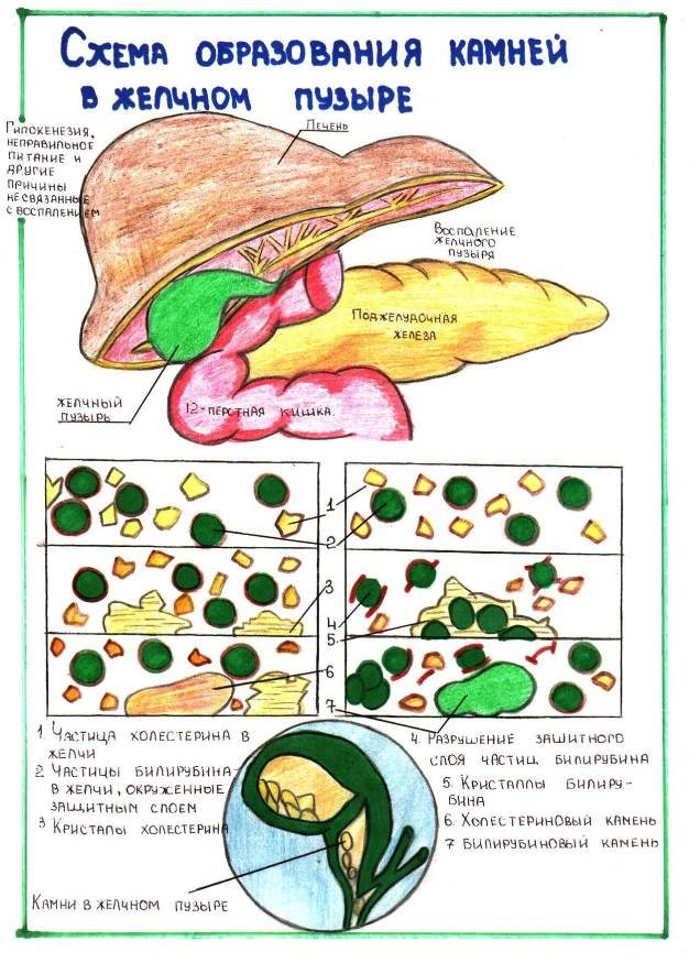 Образование камней в желчном пузыре Камни в желчном пузыре