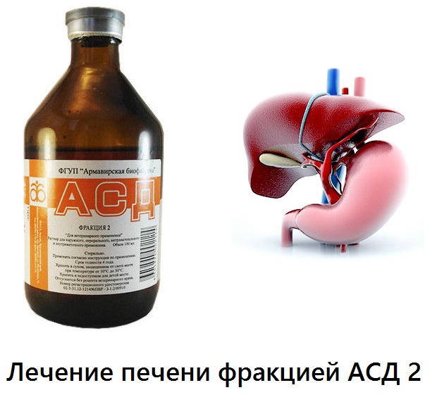 Основные положения терапии желчных камней АСД при камнях в желчном пузыре