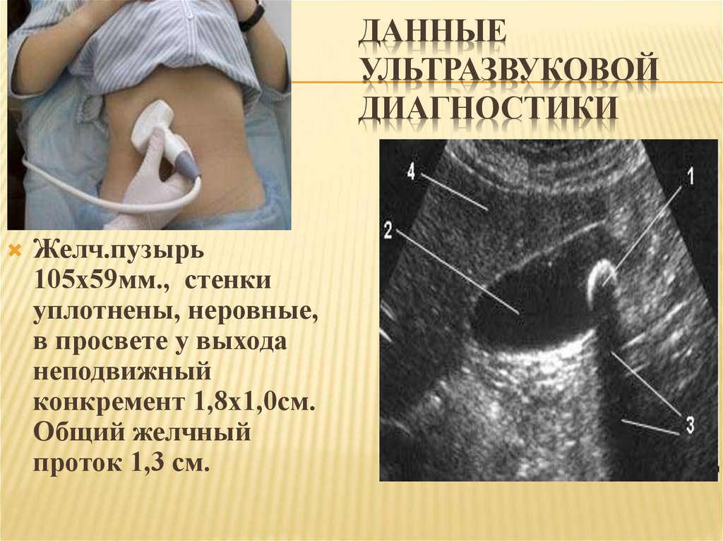 Расшифровка УЗИ желчного пузыря УЗИ желчного пузыря
