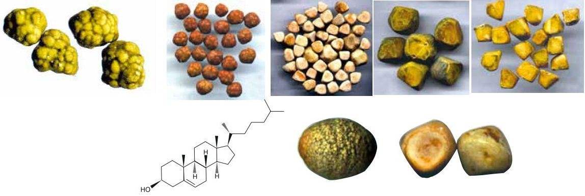 Методики безоперационного лечения желчнокаменной болезни Ультразвуковое дробление камней в желчном пузыре