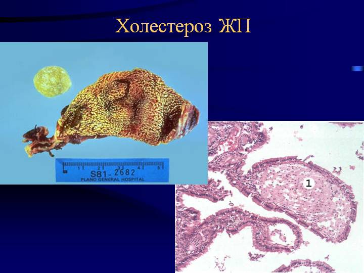 Факторы риска Холестероз желчного пузыря – что это такое?