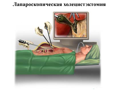 Способы проведения операции холецистэктомии Температура после удаления желчного пузыря лапароскопия