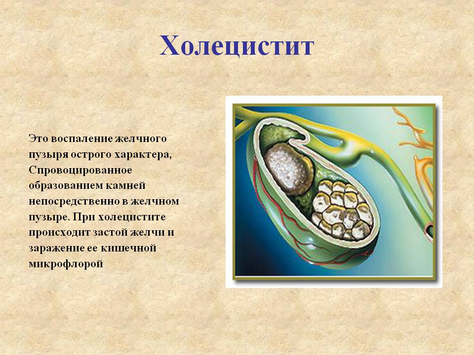 Чем является воспаление желчного пузыря? Холецистит