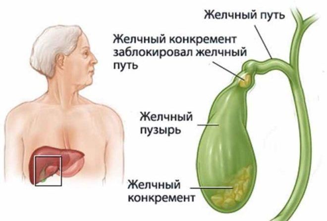Почему появляется жжение в желчном пузыре? Жжение в желчном пузыре