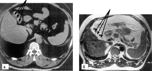 Основные методы диагностики подобных патологий КТ желчного пузыря