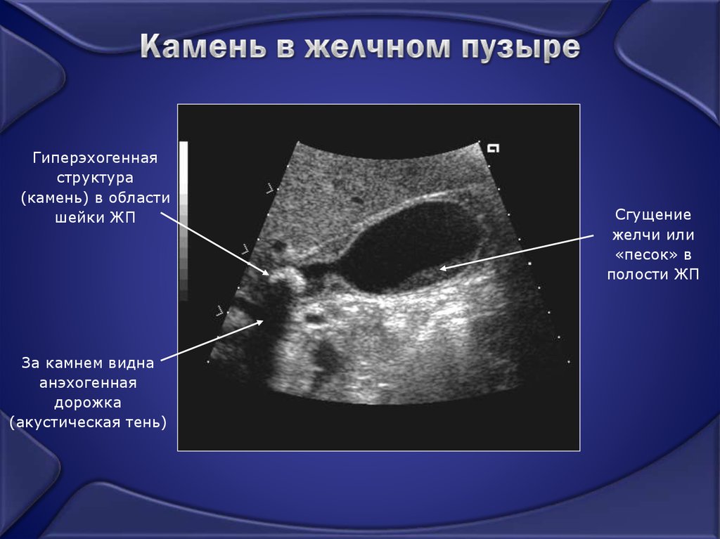 Лечение желчнокаменной болезни Литотрипсия камней в желчном пузыре