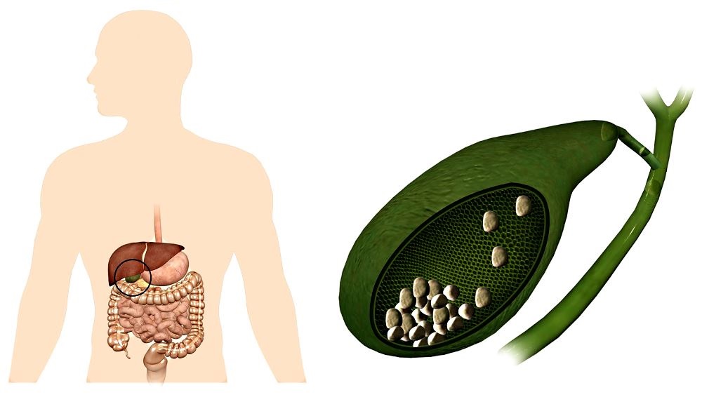 Патологии желчного пузыря Стоит ли удалять желчный пузырь если есть камни?