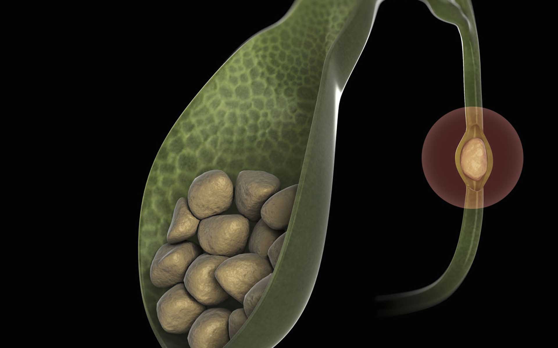 Камень в желчном пузыре – лечение без операции Чем растворить камни в желчном пузыре?