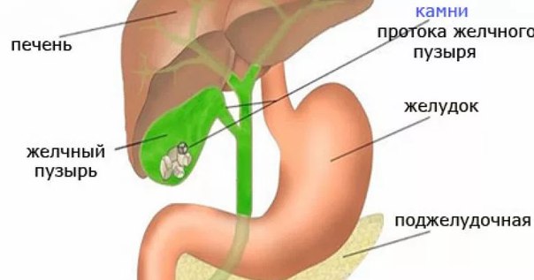 Причины камнеобразования в органе Хлопья в желчном пузыре – что это такое?
