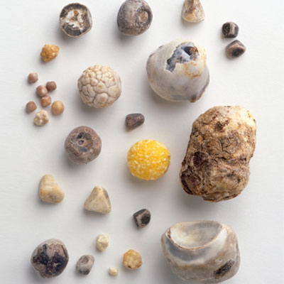 Камни в желчном пузыре Обезболивающее при камнях в желчном пузыре