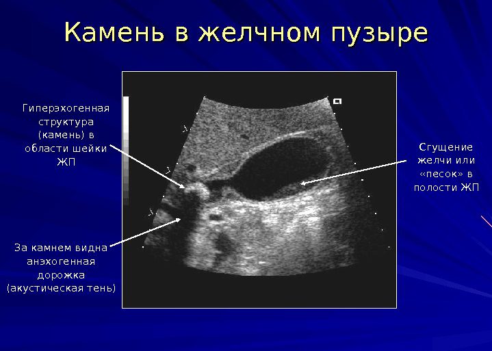 Лечения желчнокаменной болезни Камни в желчном пузыре в молодом возрасте