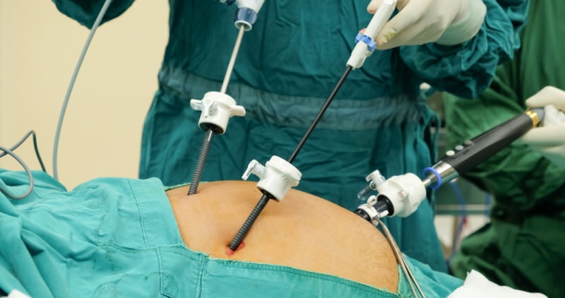 Хирургические методы удаления желчного пузыря Наркоз при лапароскопии желчного пузыря