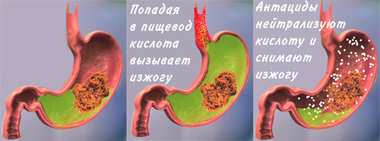 Лечение изжоги антацидами Кашель после удаления желчного пузыря