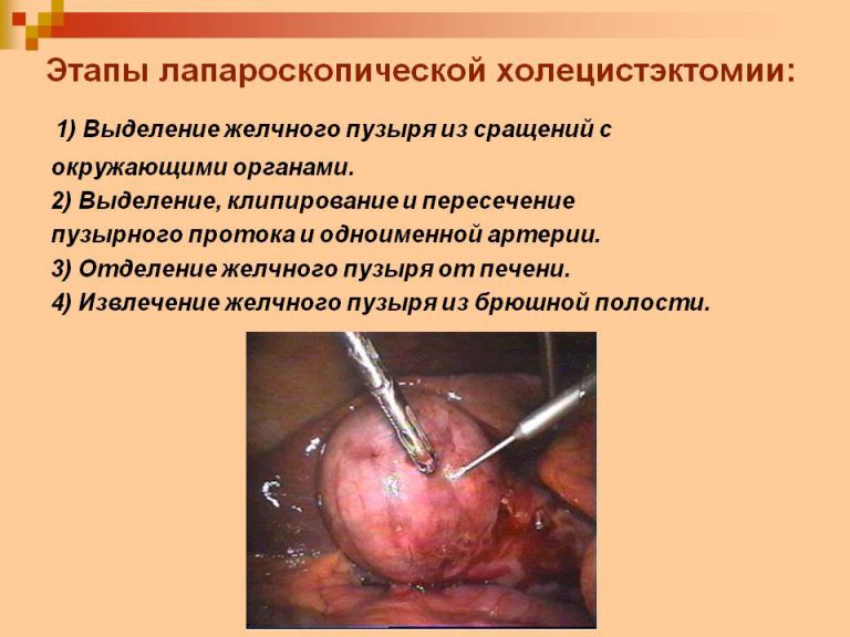 Холецистэктомия – операция по удалению желчного пузыря Панкреатит после удаления желчного пузыря
