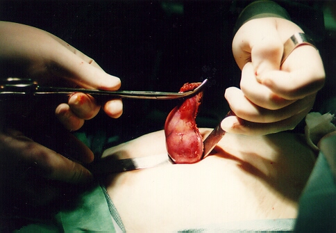 Общие правила грамотного питания после холецистэктомии Чеснок после удаления желчного пузыря