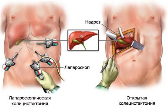 В каких случаях необходима установка такого дренажа? Трубка в желчном пузыре