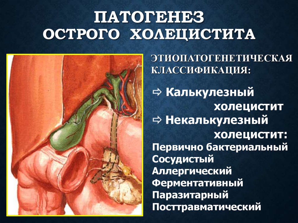 Острый холецистит Симптомы воспаления желчного пузыря у женщин