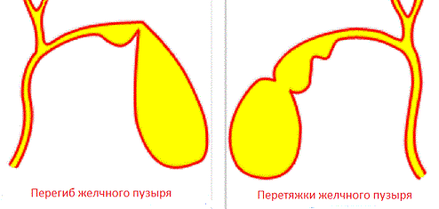 Аномалии локализации Деформация желчного пузыря