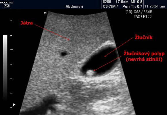 Лечение полипов в желчном пузыре Холестериновый полип желчного пузыря