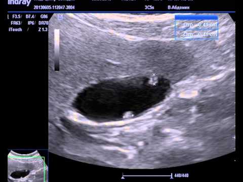 Лечение папиллом в желчном пузыре Папилломы в желчном пузыре