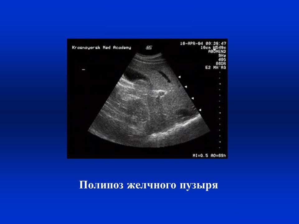 Причины появления полипов в желчном пузыре Полипы в желчном пузыре – опасно ли это?