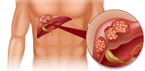 Консервативная терапия Симптомы и лечение без операции камней и полипов в желчном пузыре