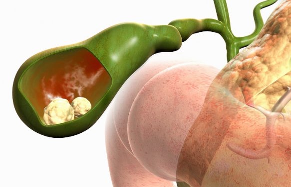 Желчнокаменная болезнь Пошли камни из желчного пузыря. Что делать?