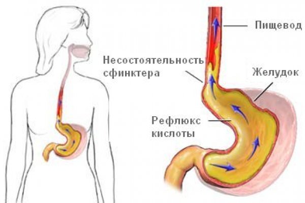 Причины появления этого синдрома Желчный рефлюкс лечение