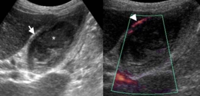 Причины подобной патологии Стенки желчного пузыря утолщены