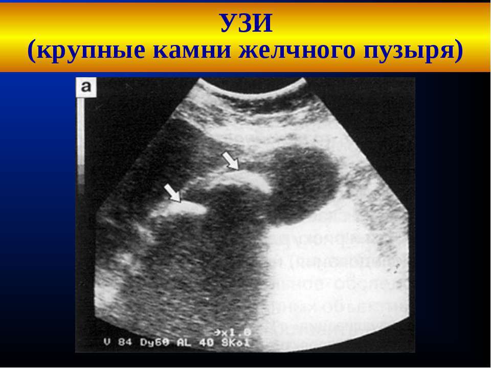 Последствия лазерного дробления желчных камней Лазерное дробление камней в желчном пузыре