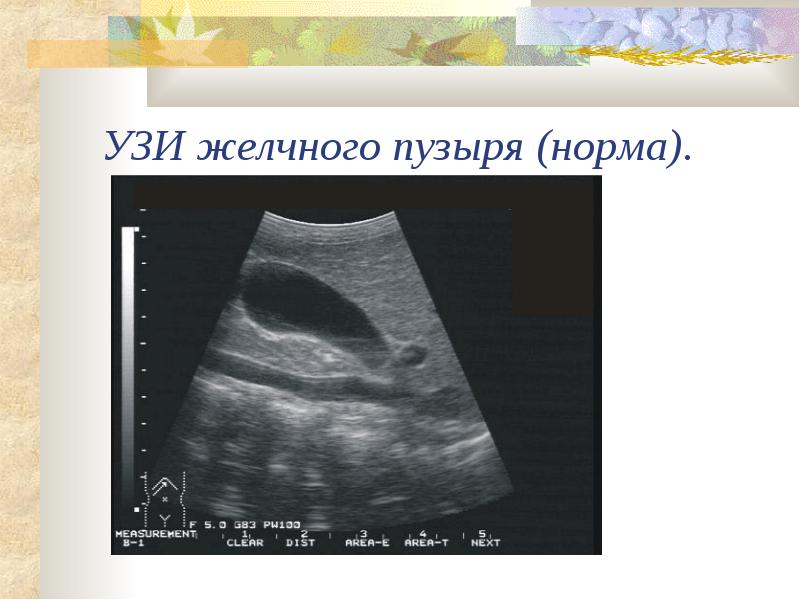 Разновидности УЗИ желчного пузыря УЗИ желчного пузыря