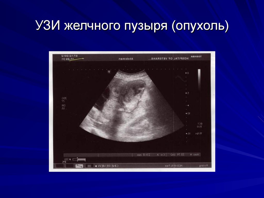 Патологии полости желчного пузыря при помощи УЗИ УЗИ желчного пузыря