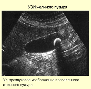 Диагностика заболеваний желчного пузыря Камни в желчном пузыре