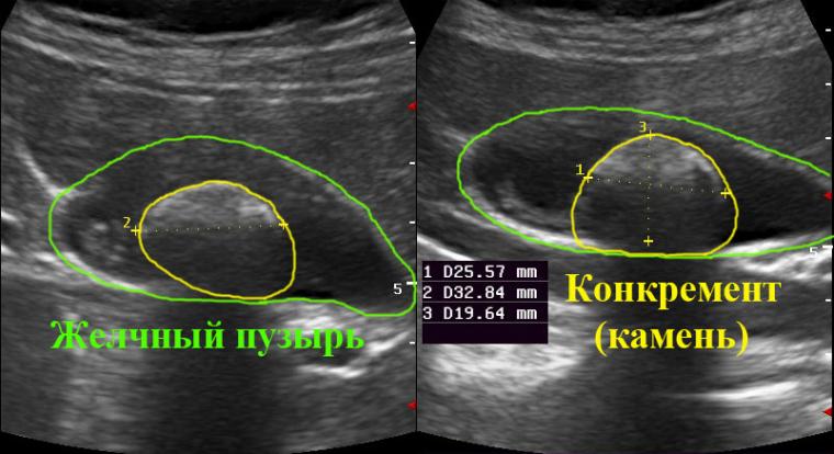 Дробление камней при помощи ультразвук Ультразвуковое дробление камней в желчном пузыре