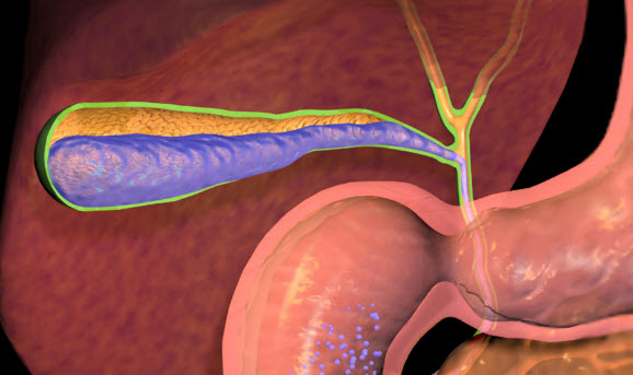 В чем разница между острым и хроническим холециститом? Камни желчного пузыря с другим холециститом