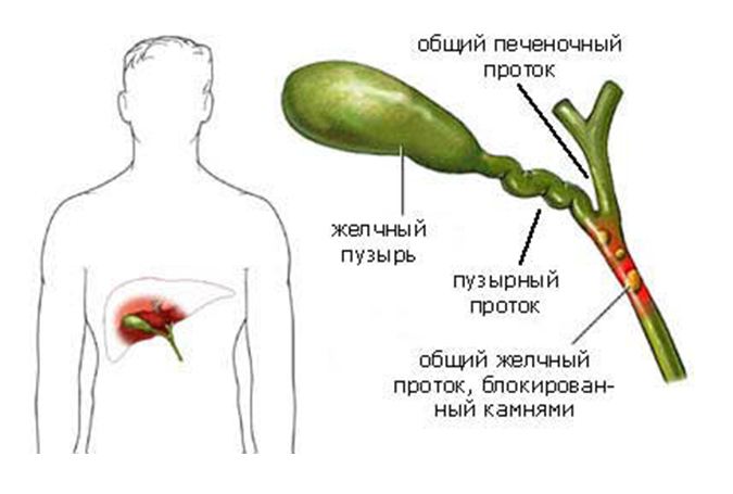 Камни в желчном пузыре Камни в желчном пузыре