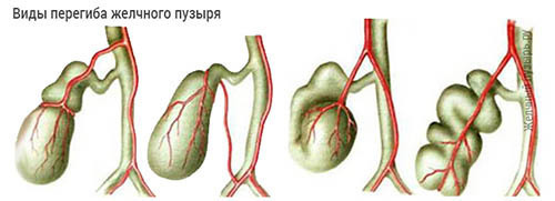 Загиб желчного пузыря Загиб желчного пузыря