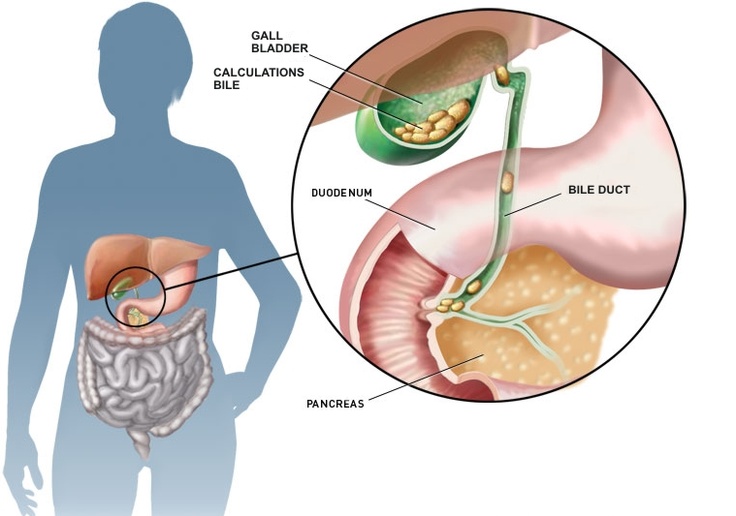 Желчегонные продукты, помогающие при застоях желчи Желчегонные продукты, помогающие при застоях желчи