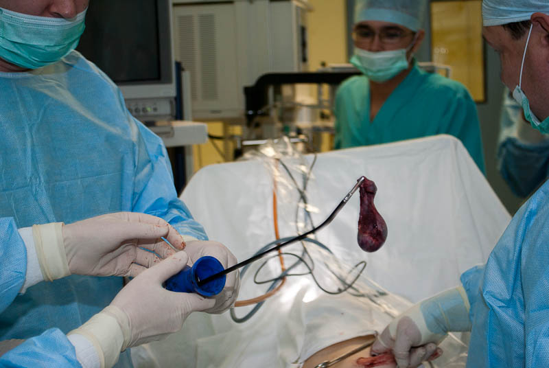 Удаление желчного пузыря После удаления желчного пузыря можно пить?